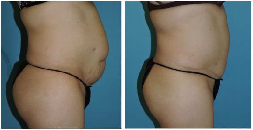 Abdominoplasty Before & After