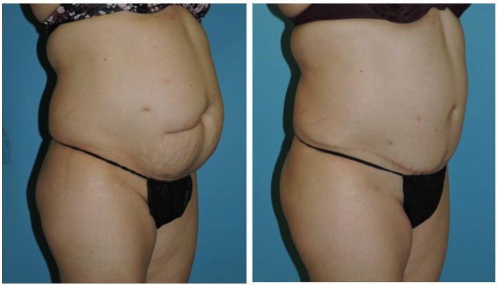 Abdominoplasty Before & After