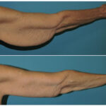 Thumbnail of http://Brachioplasty%20Before%20and%20After