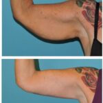 Thumbnail of http://Brachioplasty%20Before%20and%20After