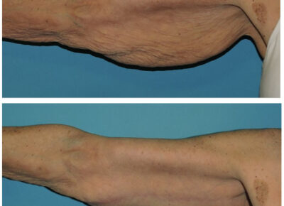 Brachioplasty – Dr. Snyder Patient 1