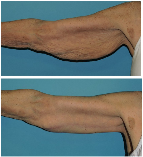 Brachioplasty Before and After