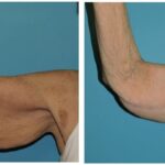 Thumbnail of http://Brachioplasty%20Before%20and%20After