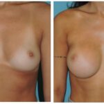 Thumbnail of http://Breast%20Augmentation%20Before%20&%20After
