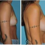 Thumbnail of http://Breast%20Augmentation%20Before%20&%20After