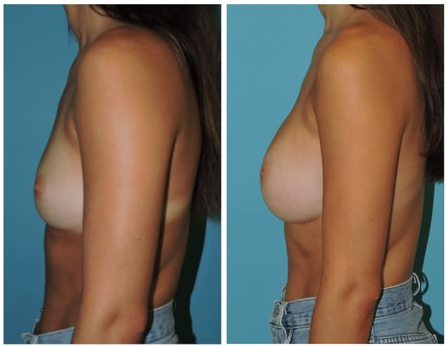 Breast Augmentation Before & After