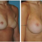 Thumbnail of http://Breast%20Augmentation%20Before%20&%20After