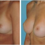 Thumbnail of http://Breast%20Augmentation%20Before%20&%20After