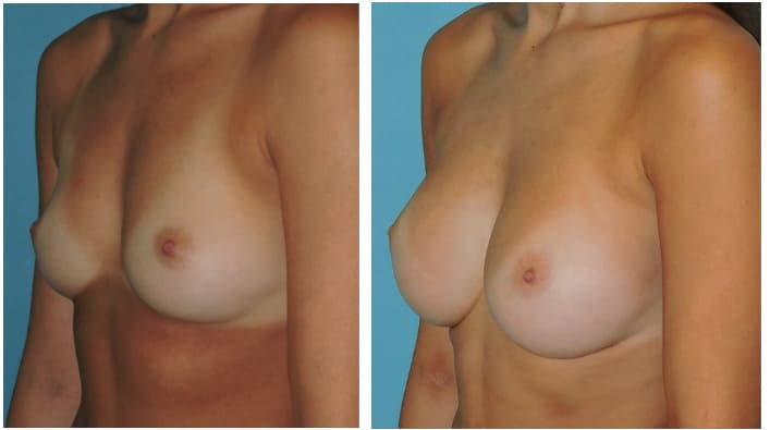 Breast Augmentation Before & After