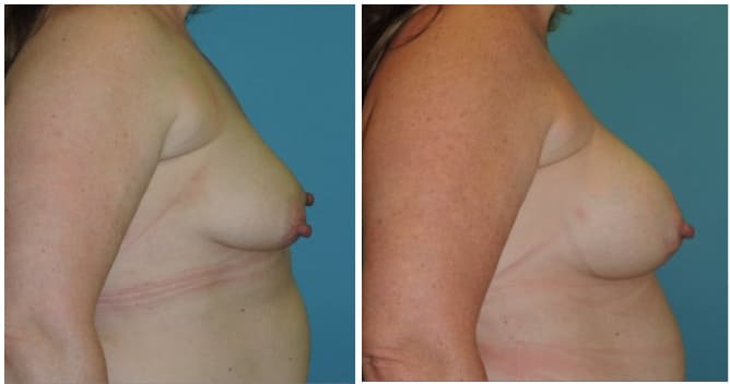 Breast Augmentation Before & After