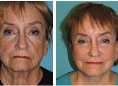 Facelift – Dr. Snyder Patient 10