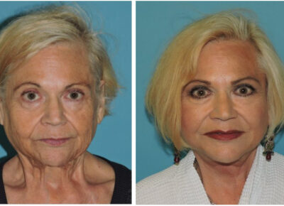 Facelift – Dr. Snyder Patient 11