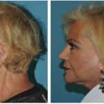 Thumbnail of http://Facelift%20Before%20and%20After