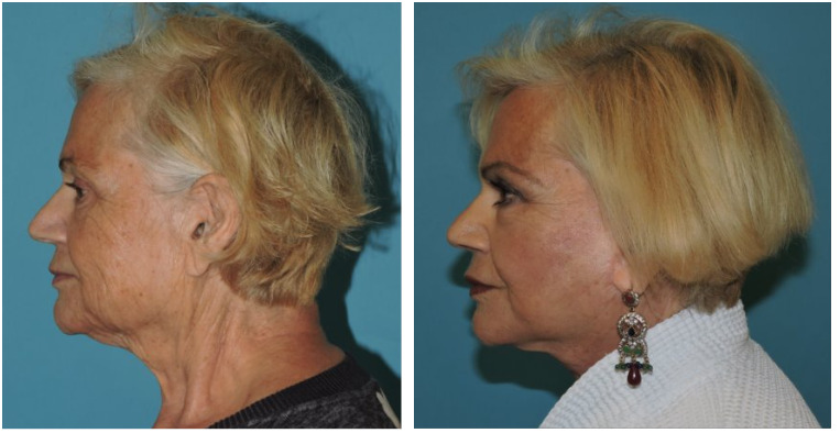 Facelift Before and After