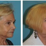 Thumbnail of http://Facelift%20Before%20and%20After