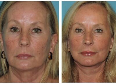 Facelift – Dr. Snyder Patient 9