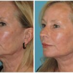 Thumbnail of http://Facelift%20Before%20and%20After