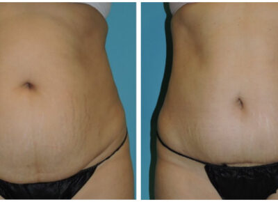 Abdominoplasty – Dr. Snyder Patient 14