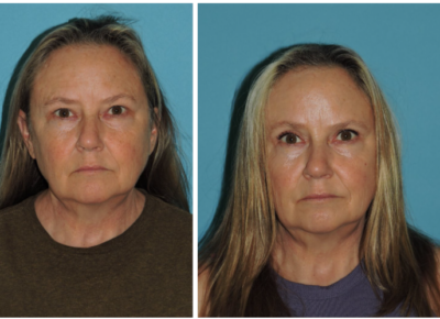 Brow Lift – Dr Snyder Patient 1
