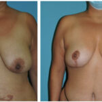Thumbnail of http://Mastopexy%20Before%20&%20After