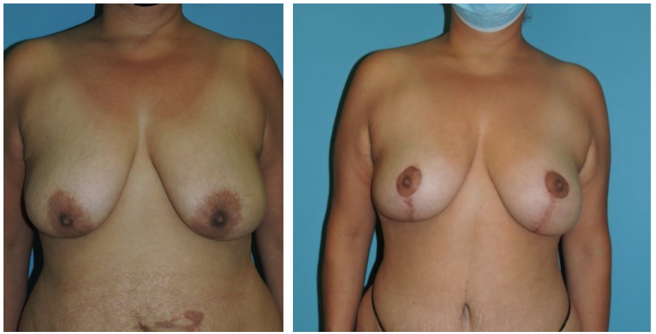 Mastopexy Before & After