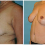 Thumbnail of http://Mastopexy%20Before%20&%20After