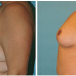 Thumbnail of http://Mastopexy%20Before%20&%20After