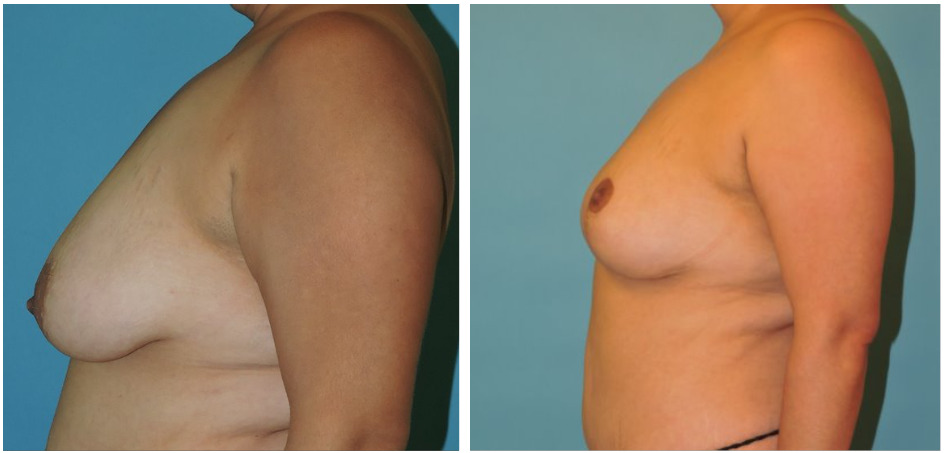 Mastopexy Before & After