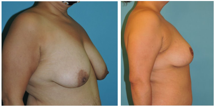 Mastopexy Before & After