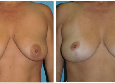 Breast Lift with Implants – Dr. Snyder Patient 11