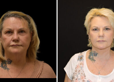 Face and Neck Lift – Dr. Zeiderman Patient 2