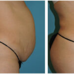 Thumbnail of http://Abdominoplasty%20Before%20&%20After