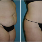 Thumbnail of http://Abdominoplasty%20Before%20&%20After