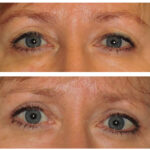 Thumbnail of http://Blepharoplasty%20Before%20&%20After