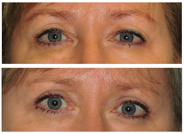 Blepharoplasty Before & After