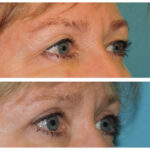 Thumbnail of http://Blepharoplasty%20Before%20&%20After