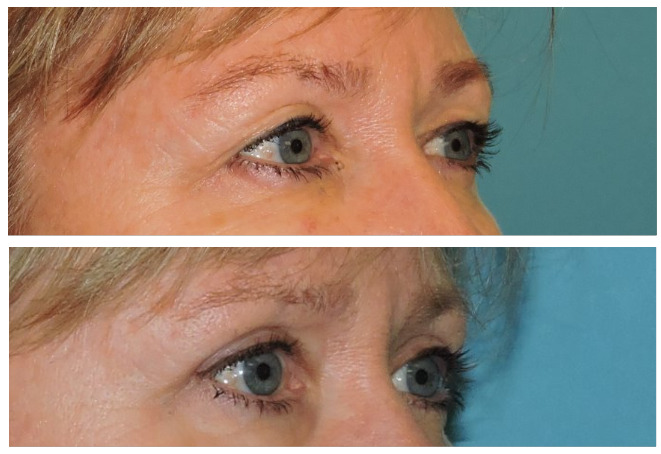 Blepharoplasty Before & After