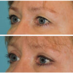 Thumbnail of http://Blepharoplasty%20Before%20&%20After