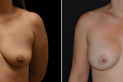 Breast Procedure – Dr Zeiderman Patient 12
