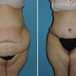 Thumbnail of http://abdominoplasty%20before%20and%20after