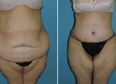 Abdominoplasty with Liposuction – Dr. Thorburn Patient 1