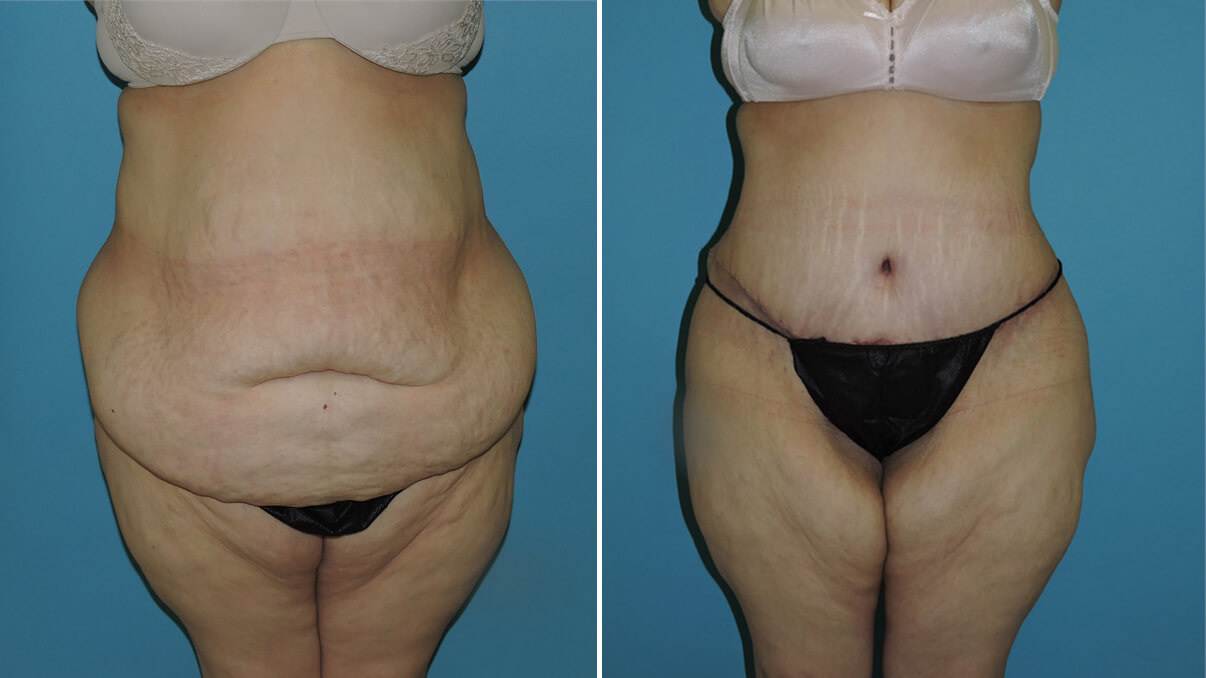 abdominoplasty before and after