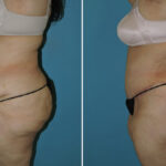 Thumbnail of http://abdominoplasty%20before%20and%20after