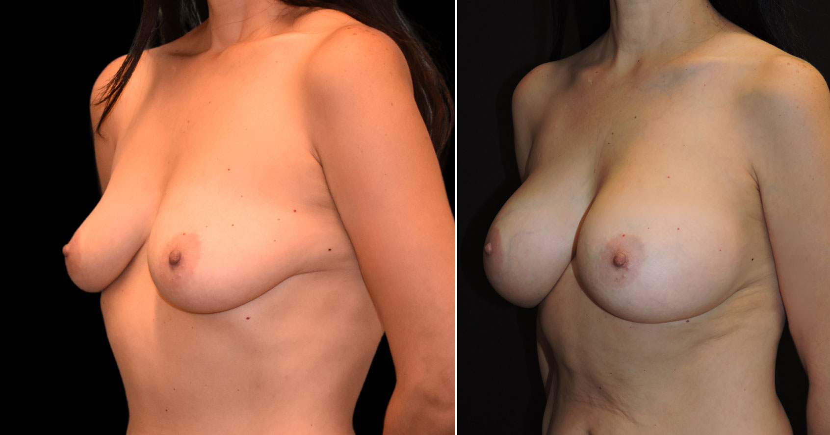 breast augmentation before & after