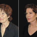 Thumbnail of http://before%20and%20after%20of%20facelift%20patient