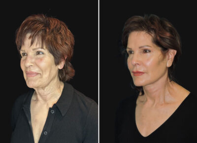 Facelift – Dr. Zeiderman Patient 1
