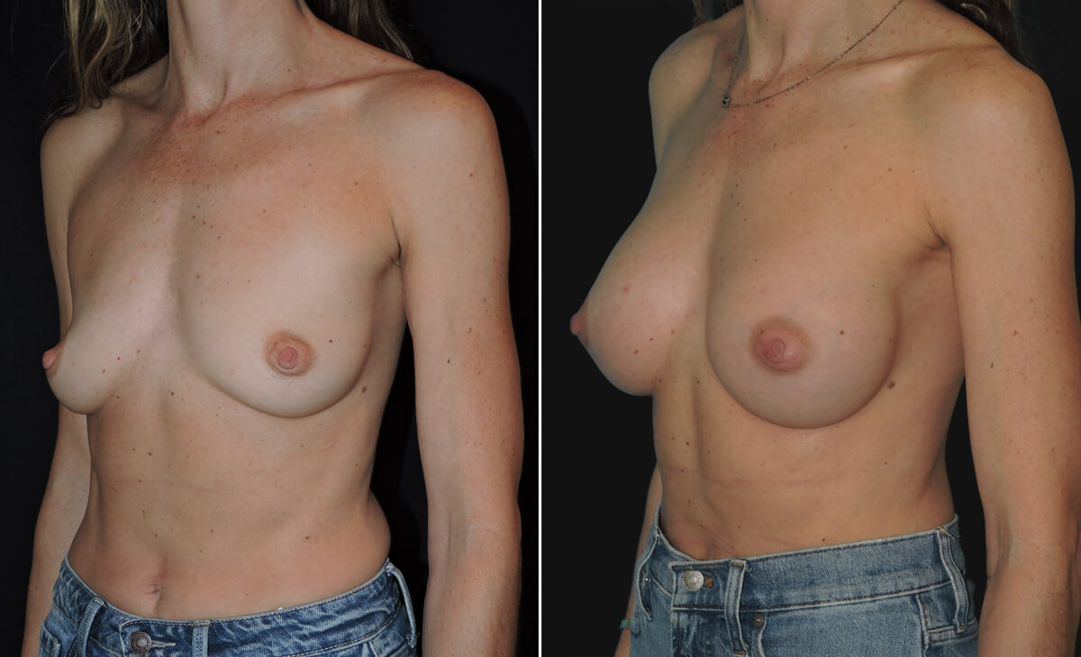 before and after of breast augmentation