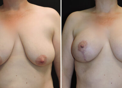 Breast Lift with Implants – Dr. Zeiderman