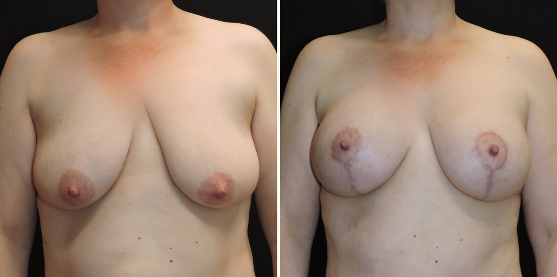 breast-lift-implants-patient