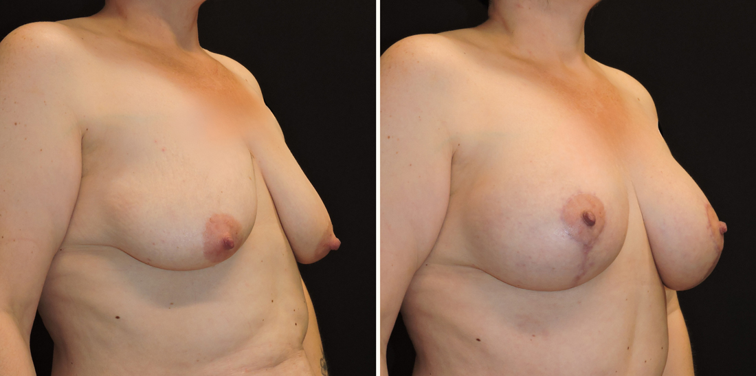 breast-lift-implants-patient